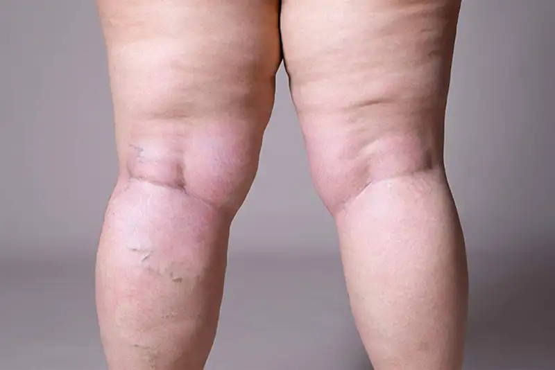 exemplo de pernas femininas com diagnóstico de lipedema.